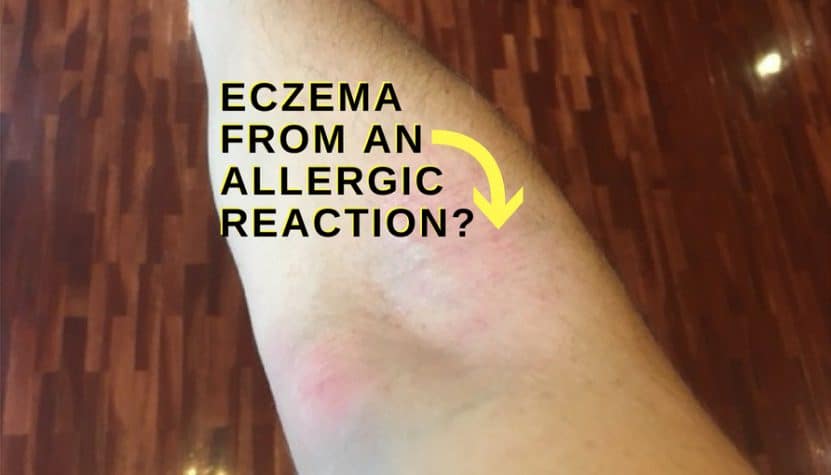 Can eczema be an allergic reaction