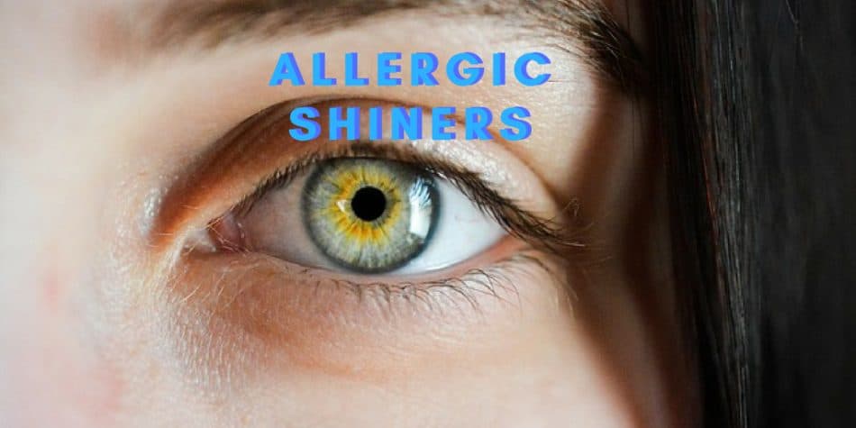 do allergic shiners go away