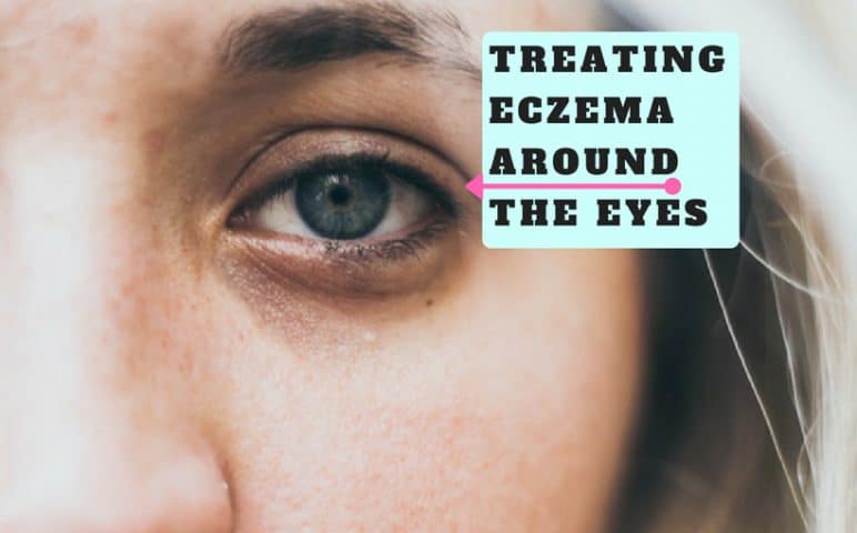 treating eczema around the eyes - natural remedies